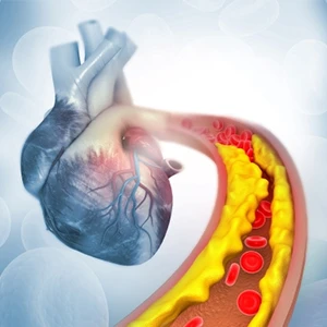 Arteriosclerosis