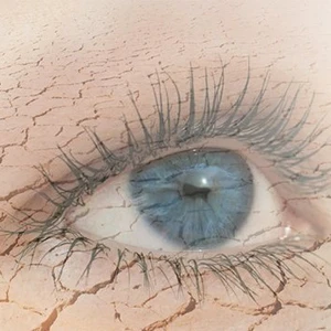 Dry Eyes