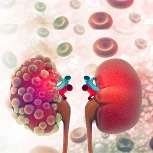 Kidney Cancer