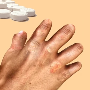 Leprosy