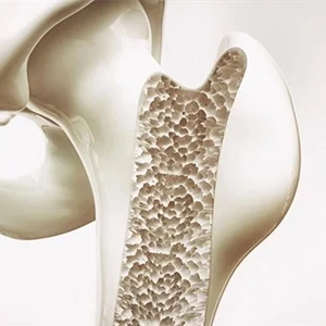 Osteoporosis