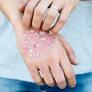 Skin Diseases