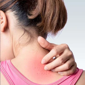 Anti Itching